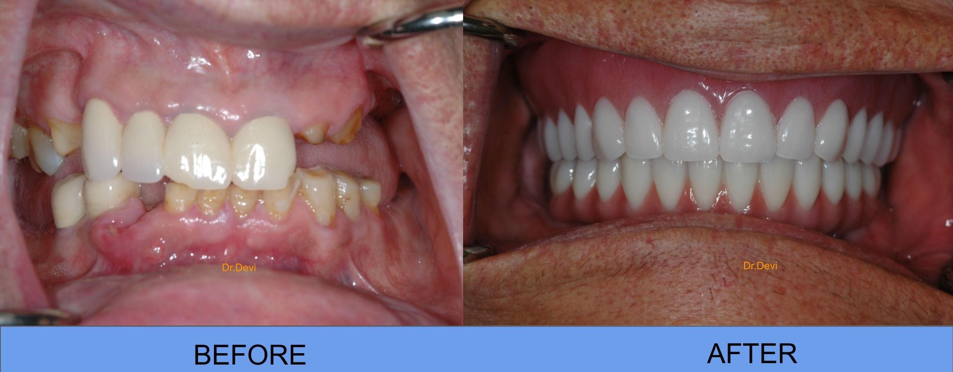 All-on-4 full arch implant restoration result by Dr. Devi