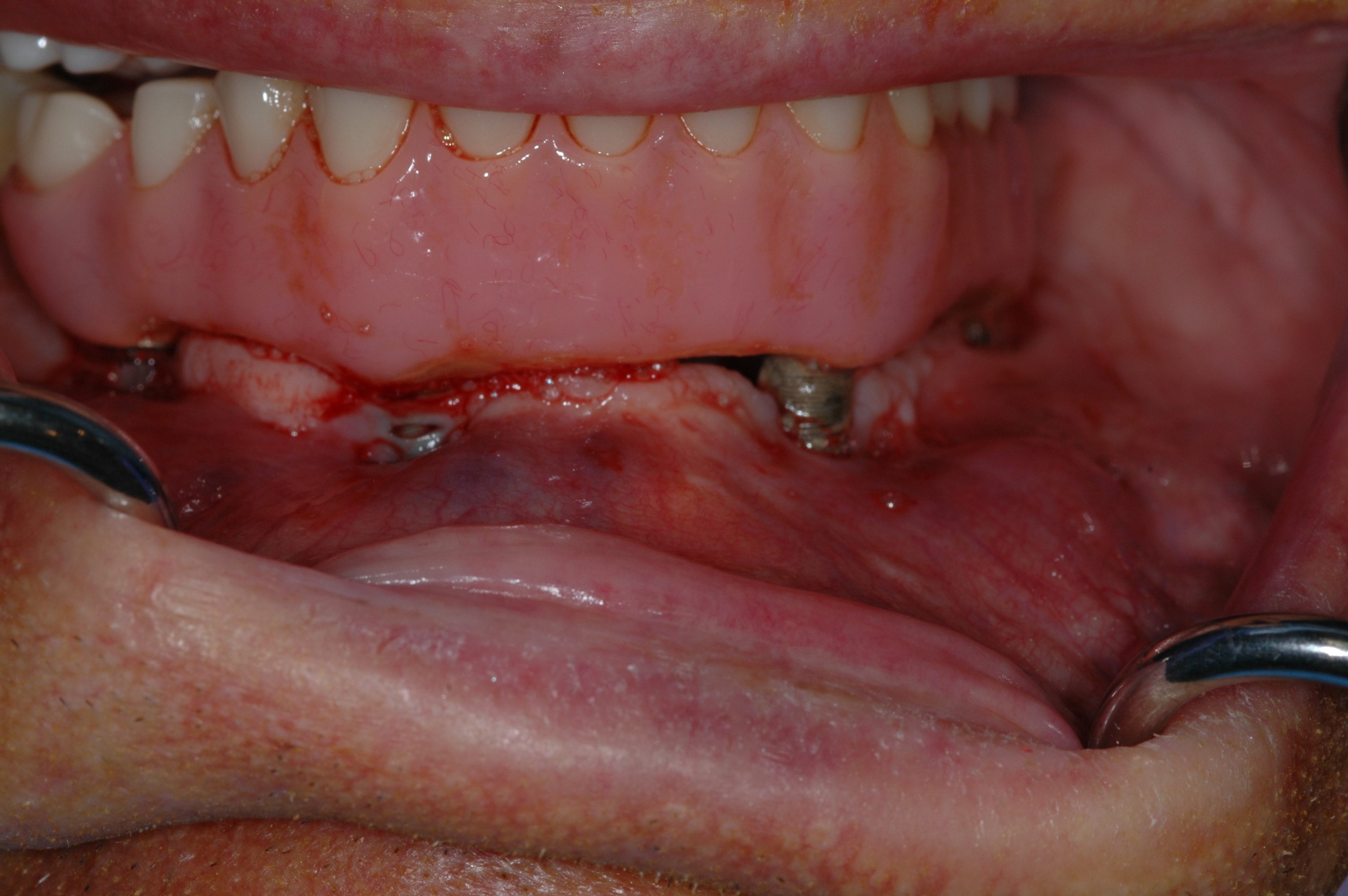 Lower mouth showing a dental implant failure