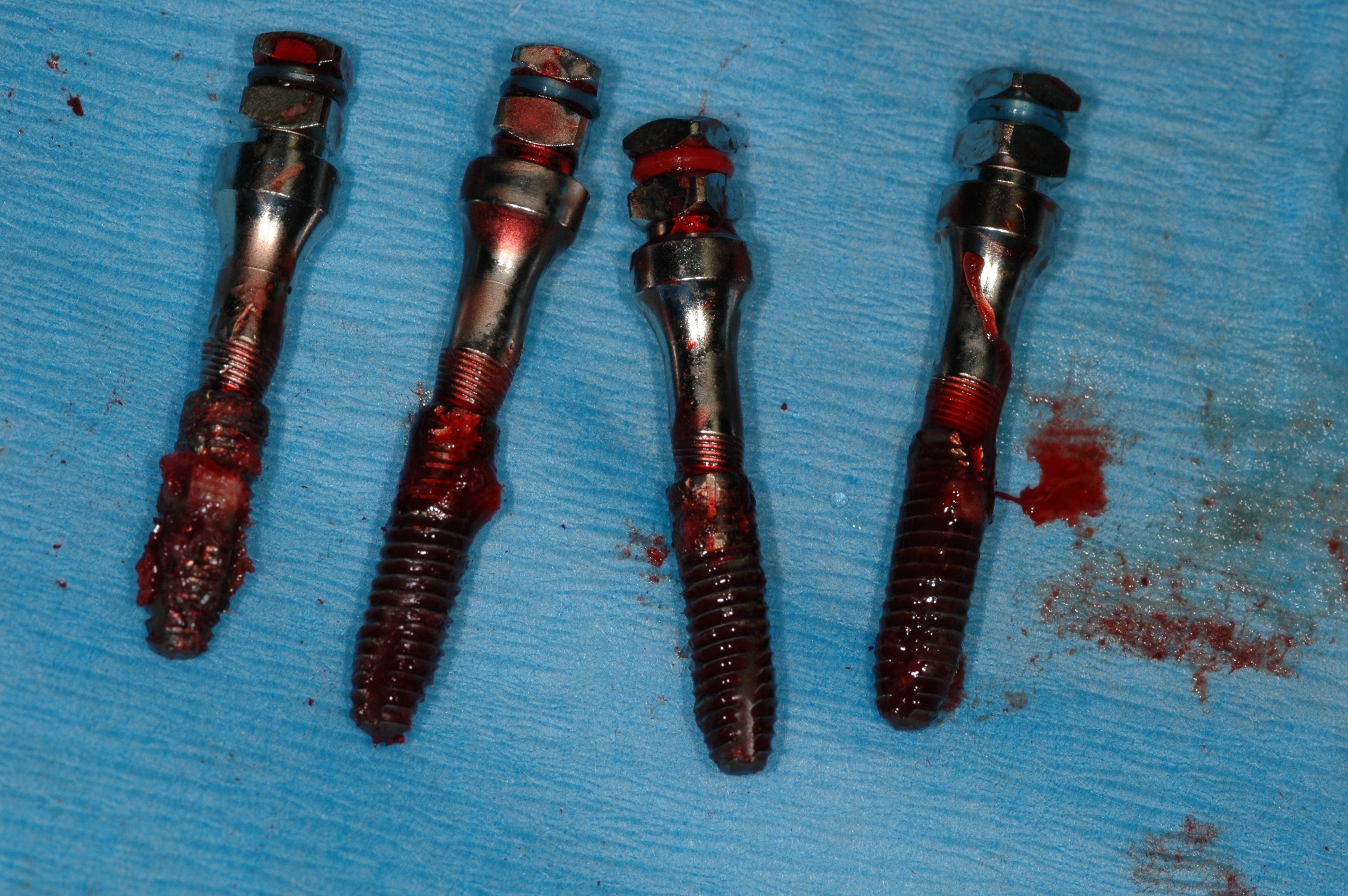 Failed dental implants removed during treatment