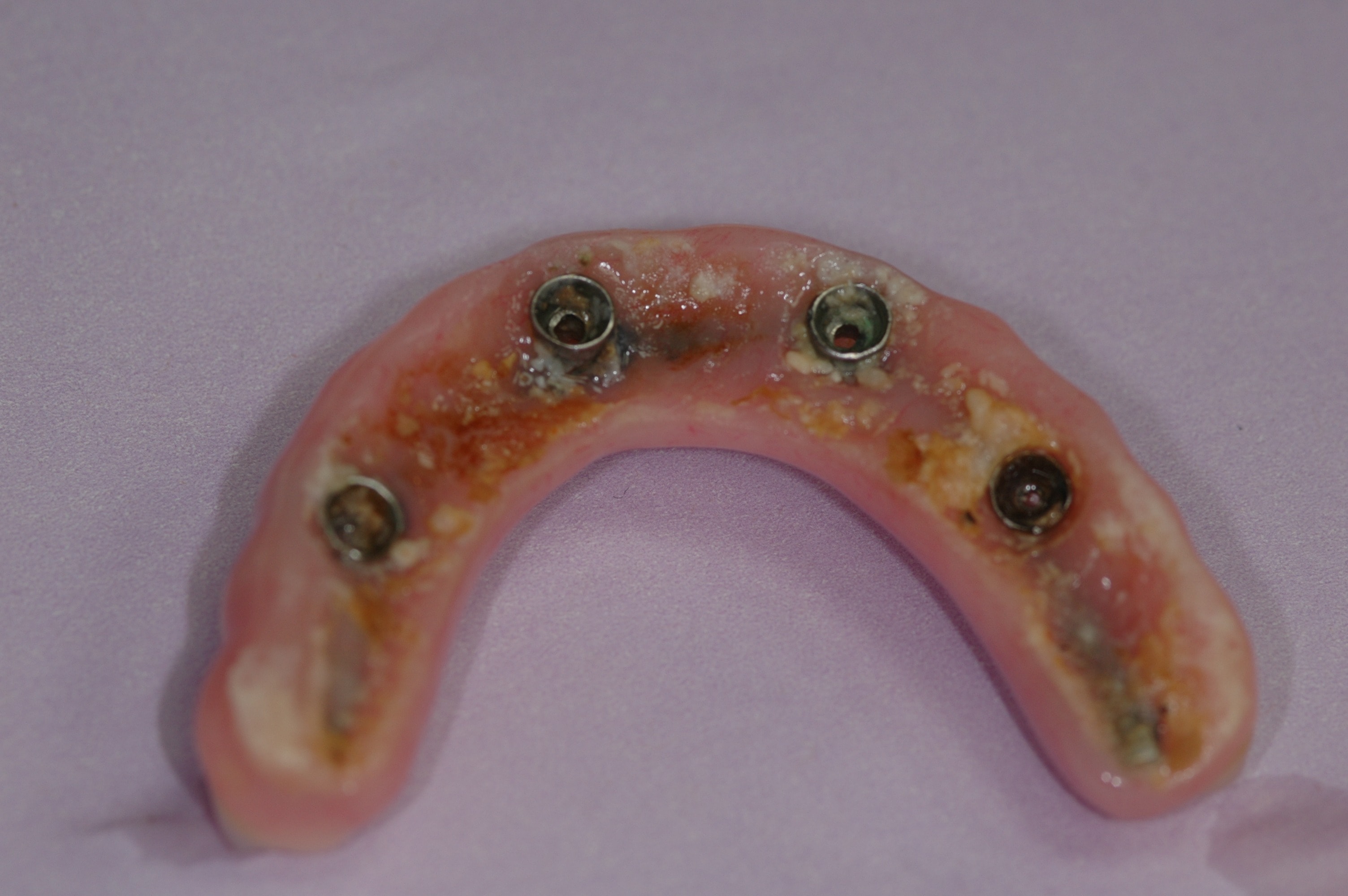 Poorly designed All-on-4 prosthesis causing a food trap