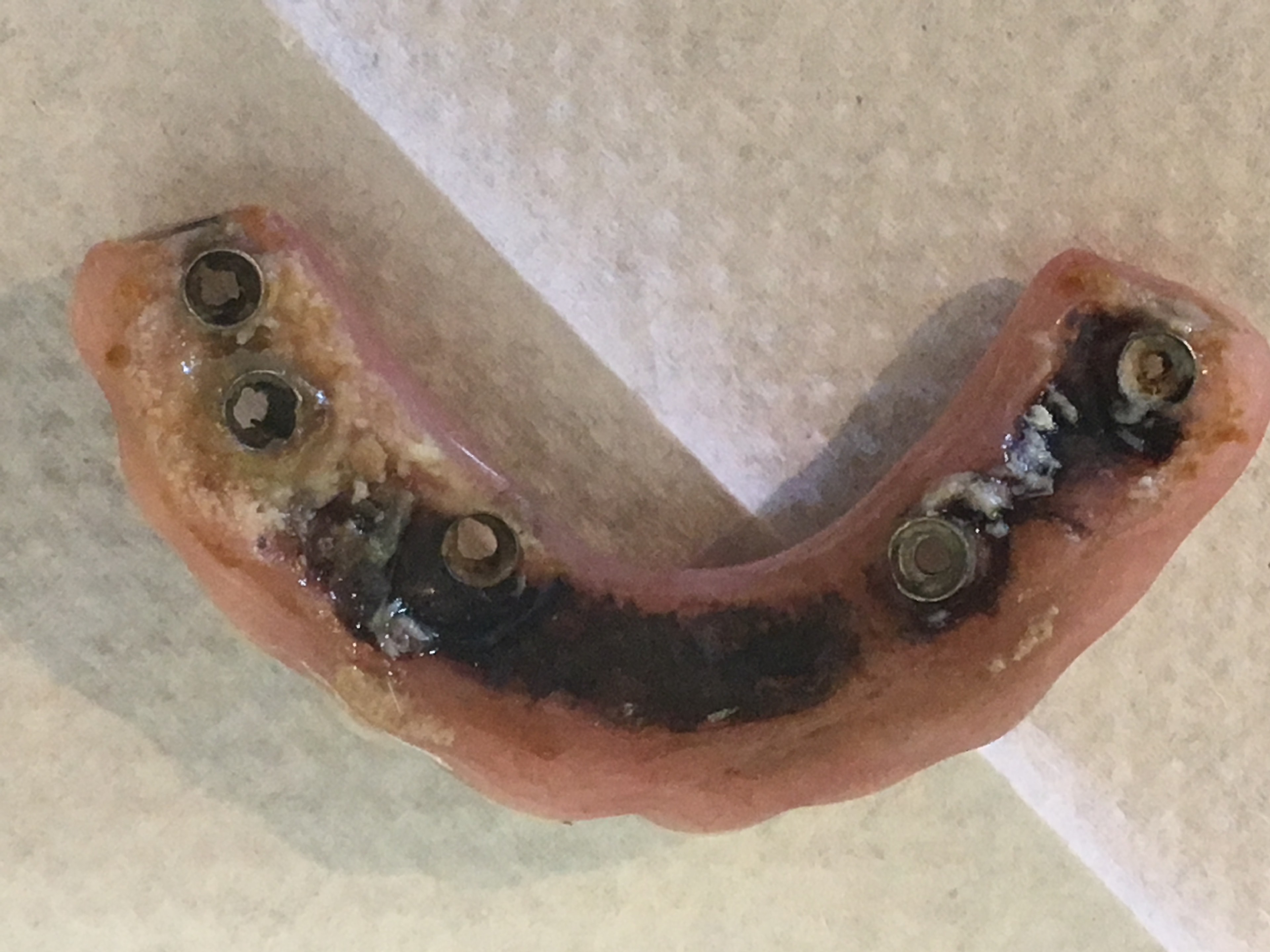 Poorly constructed All-on-4 prosthesis