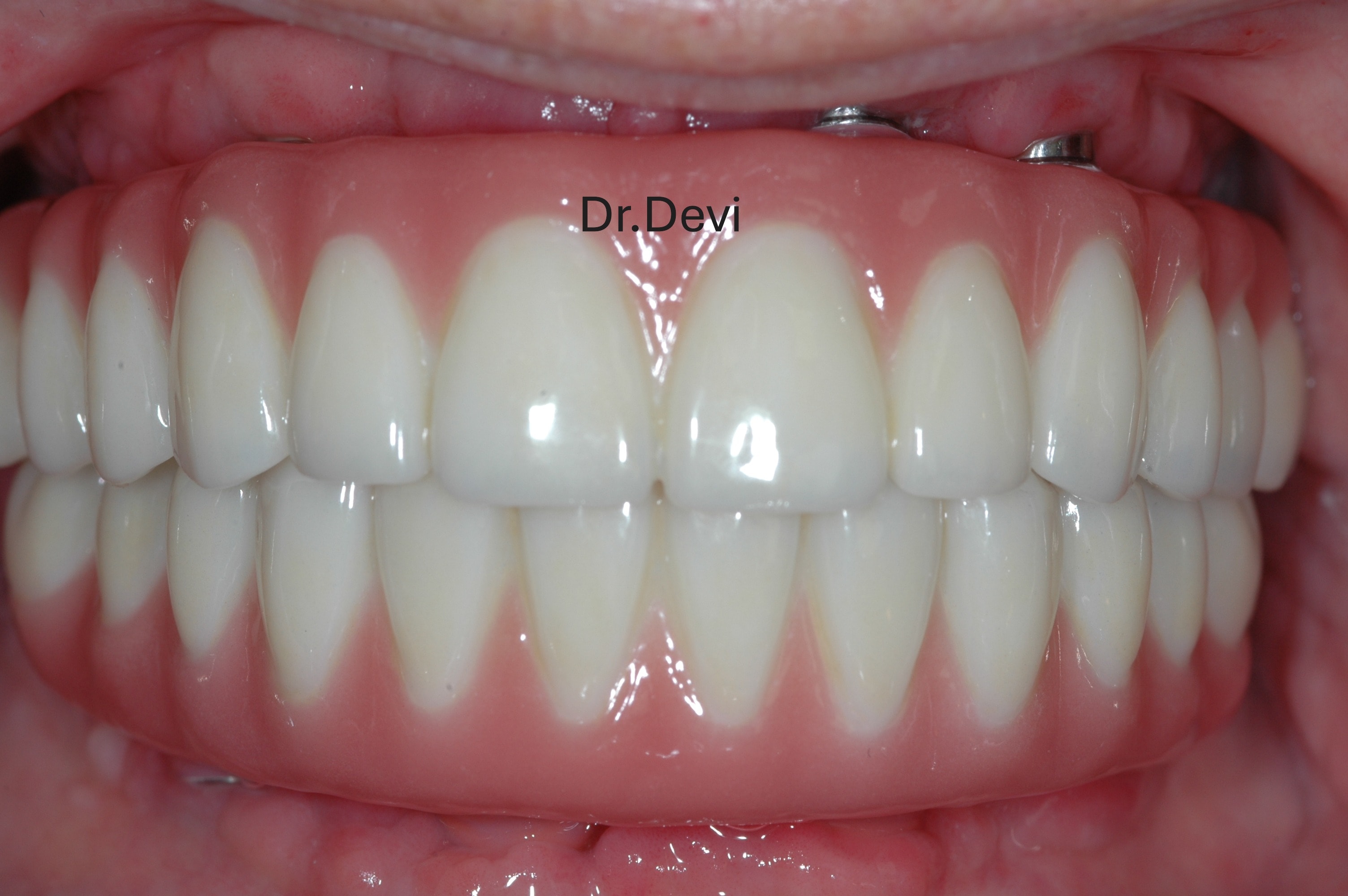All-on-4 full arch implant restoration result by Dr. Devi showing natural-looking teeth