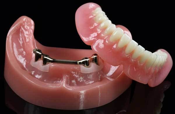 Bar-retained overdenture showing custom metal bar connecting implants with removable denture