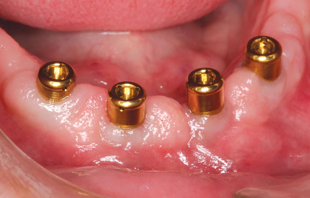 Four gold implant locator attachments in gum tissue for overdenture support