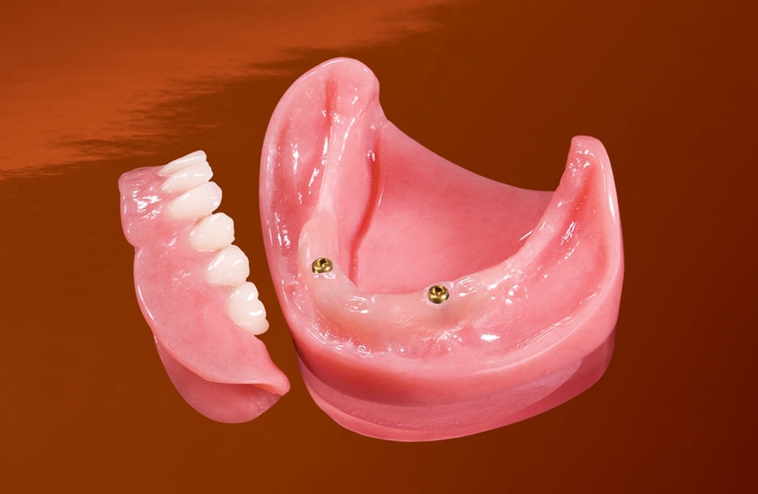 Removable overdenture supported by two implant locator attachments