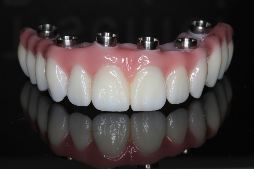 Prettau zirconia bridge full arch implant-supported restoration with screw access holes