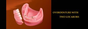 Overdenture with Two Locators in surprise az