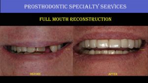Prosthodontic Speciality Services - Full Mouth Reconstruction 